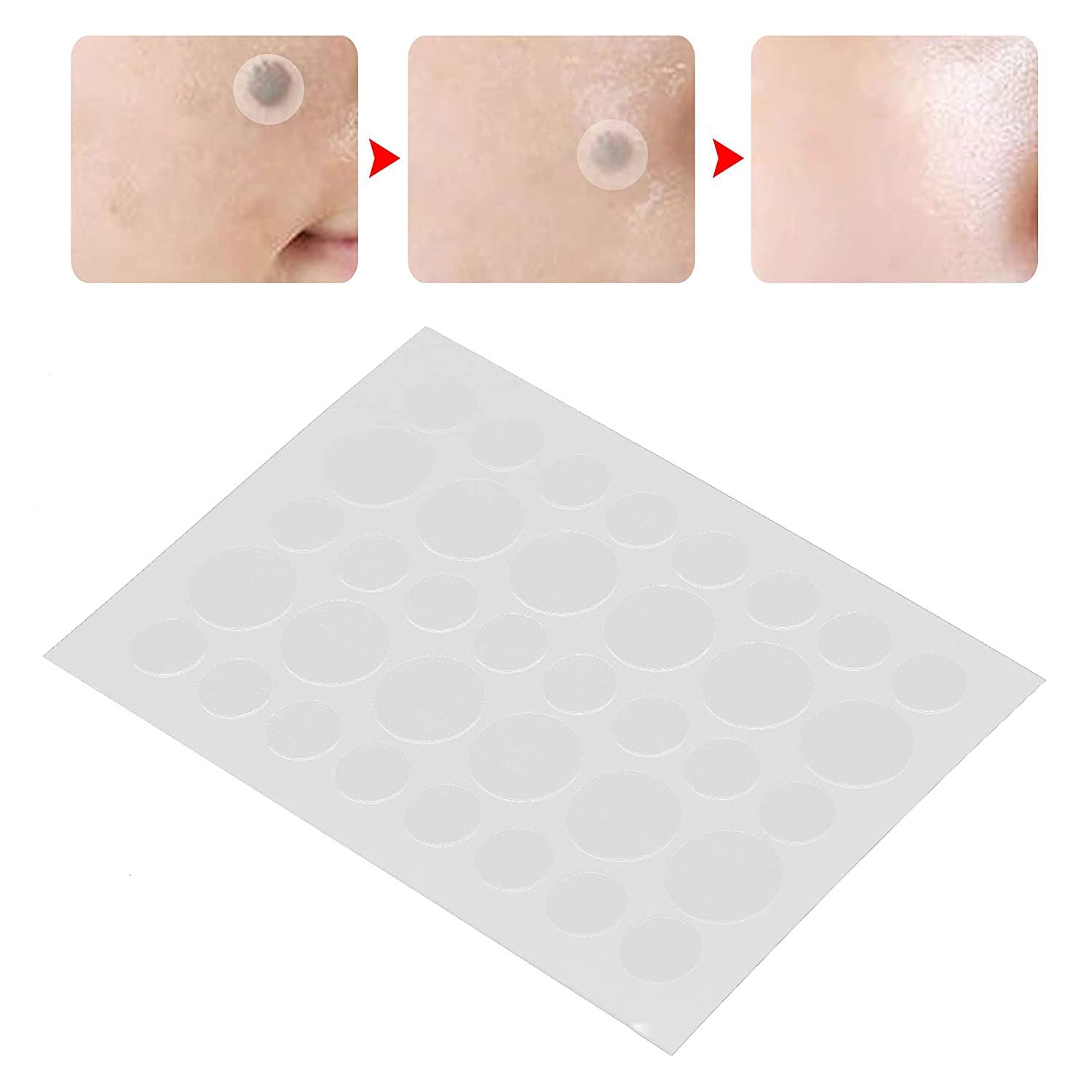 The Shield | Premium Hydrocolloid Acne & Skin Tag Healing Patches (108 Dots Value Pack)